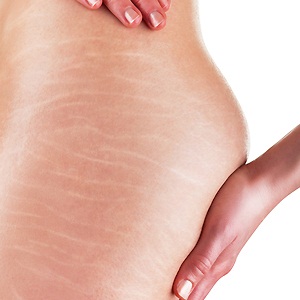 stretch marks